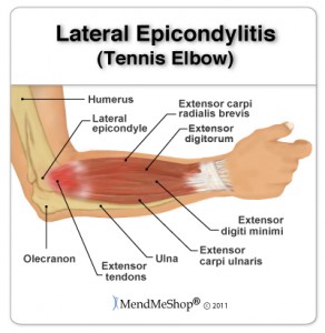 Lateral Epicondylitis, a.k.a. “Tennis Elbow” | Austin Sports Therapy