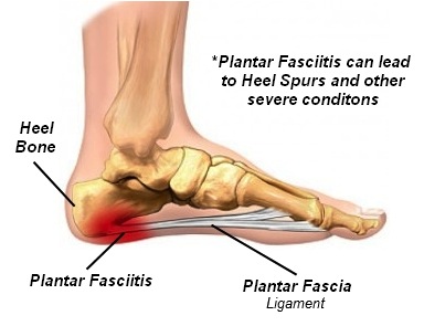 Plantar Fasciitis | Austin Sports Therapy